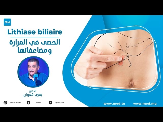 Video lithiase biliaire