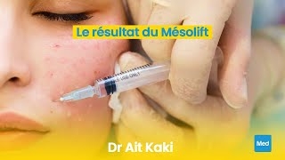 Video Le résultat du Mésolift 