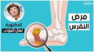 Video مرض النقرس