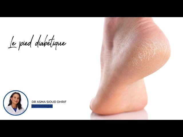 Video pied diabétique 
