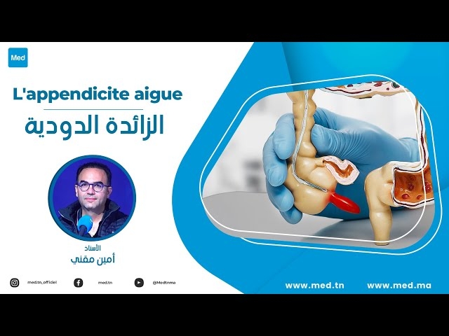 Video L'appendicite aigue
