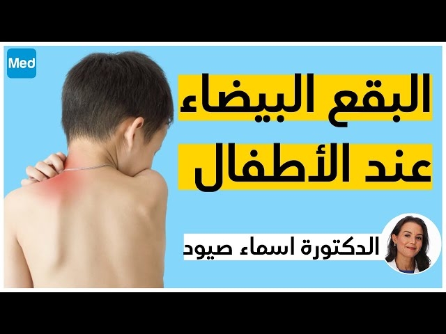 Video Les Taches blanches sur le visage chez les enfants