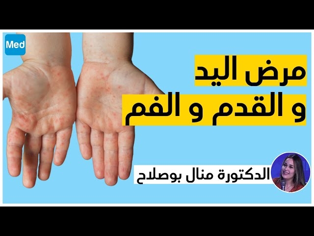 Video Syndrome mains-pieds-bouche