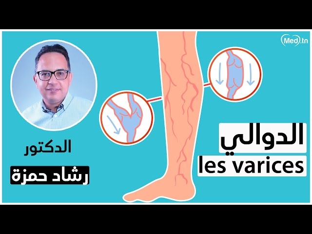 Video Les varices 