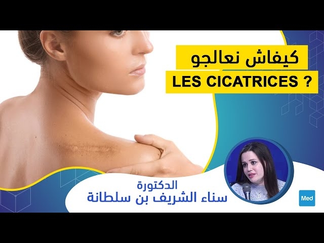 فيديو كيفاش نعالجو les cicatrices ؟