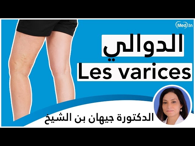 Video Les Varices 