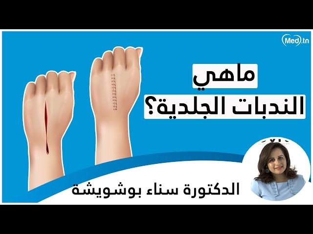 Video Les cicatrices cutanées