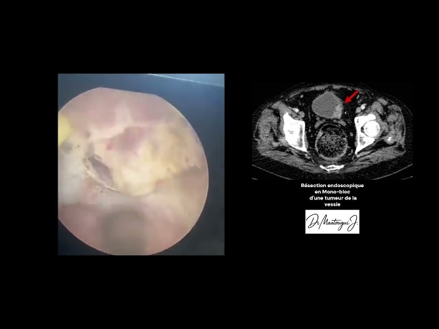 Video Résection endoscopique d'une tumeur vésicale (RTUV) en Monobloc
Dr Maatougui Jasser - Chirurgien Urologue