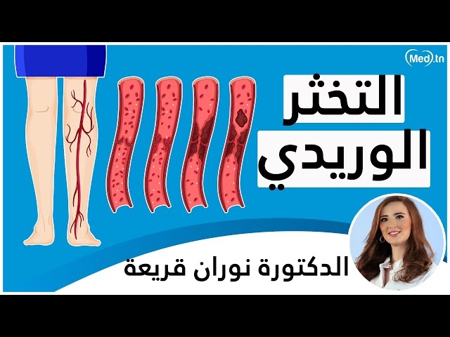 Video Thrombose veineuse