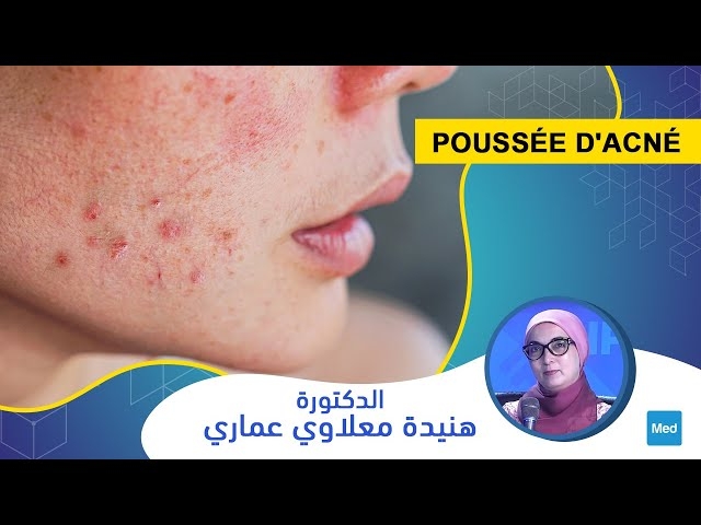 Video Poussée d'acné
