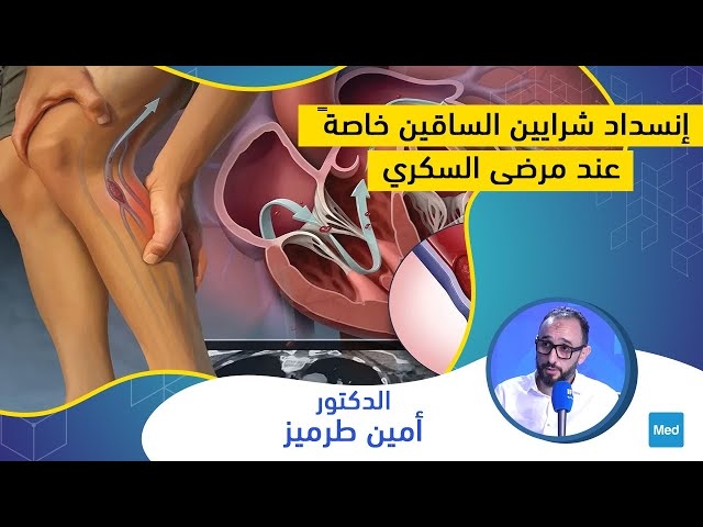 Video إنسداد شرايين الساقين خاصةً عند مرضى السكري