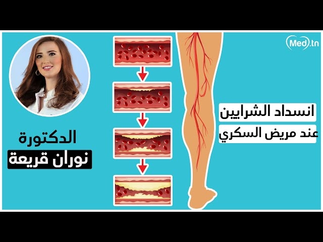 Video Artériopathie des membres inférieurs