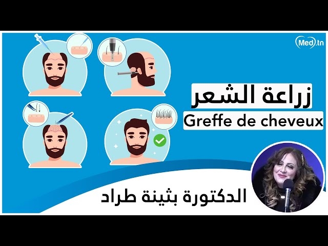 Video Greffe de cheveux 