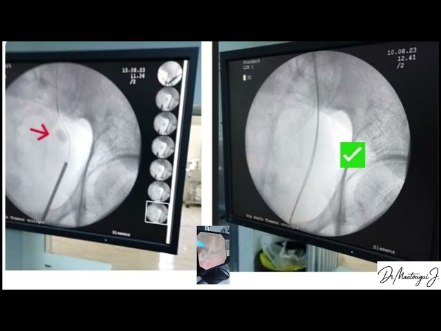 Video Vous souffrez d’un calcul urétéral ?  L’urétéroscopie laser est la solution pour vous.
Dr Maatougui Jasser - Chirurgien Urologue