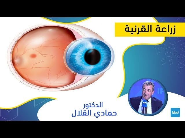 Video Greffe de cornée