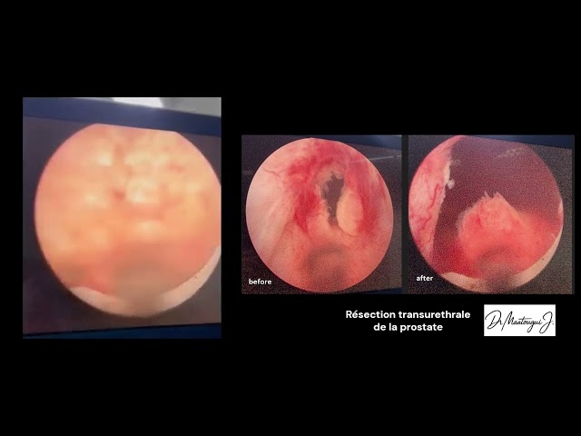 Video Résection endoscopique transuréthrale de la prostate (RTUP).
Dr Maatougui Jasser - Chirurgien Urologue