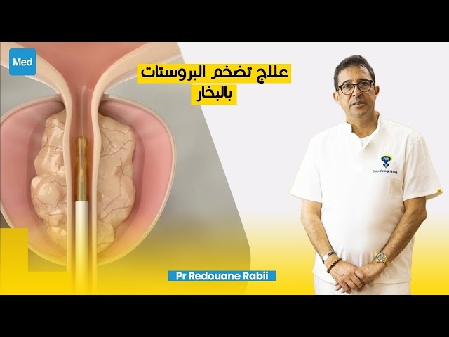 Video علاج تضخم البروستات بالبخار