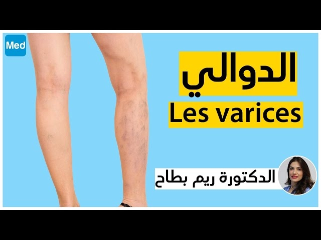 Video Les Varices 