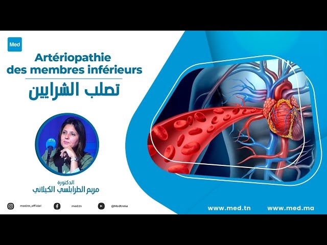 Video Artériopathie des membres inférieurs