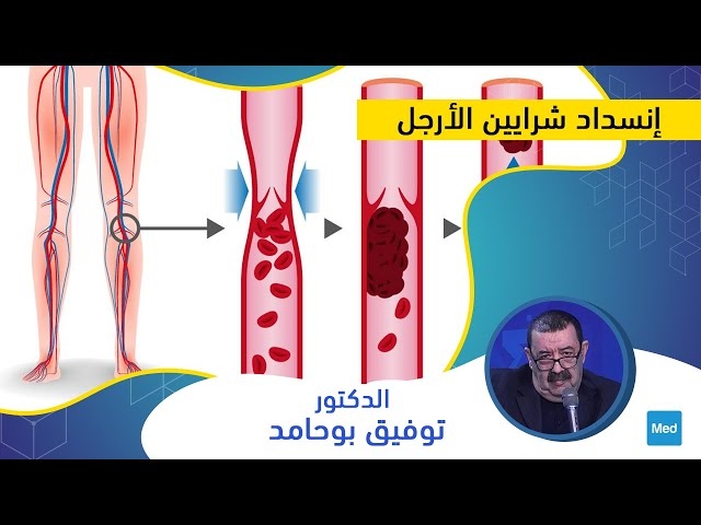 Video إنسداد شرايين الأرجل