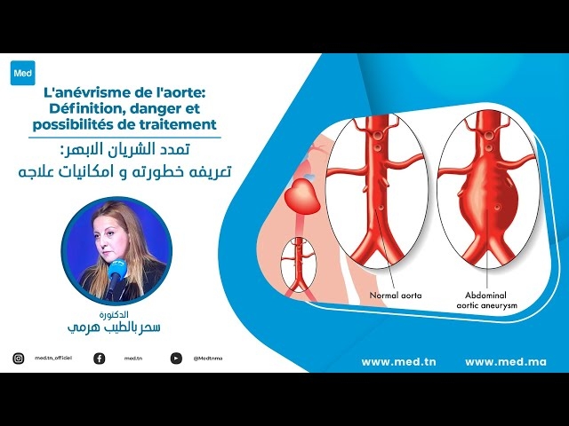 Video L'anévrisme de l'aorte: Définition, danger et possibilités de traitement