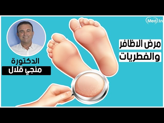 Video  Mycose des ongles