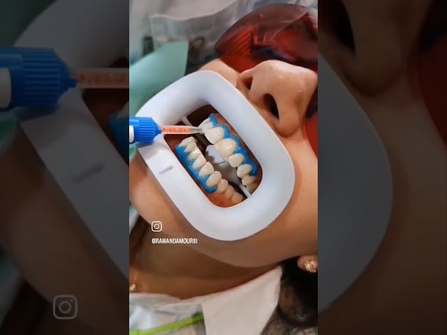 Video Blanchiment dentaire