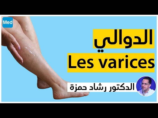 Video Les Varices 