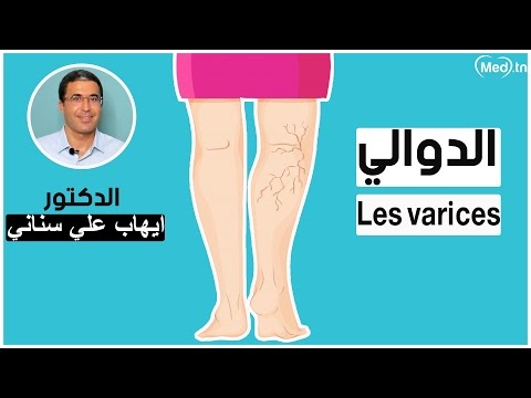 Video  les varices