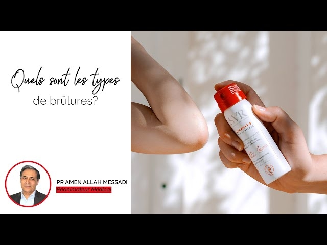 Video Quels sont les types de brûlures?