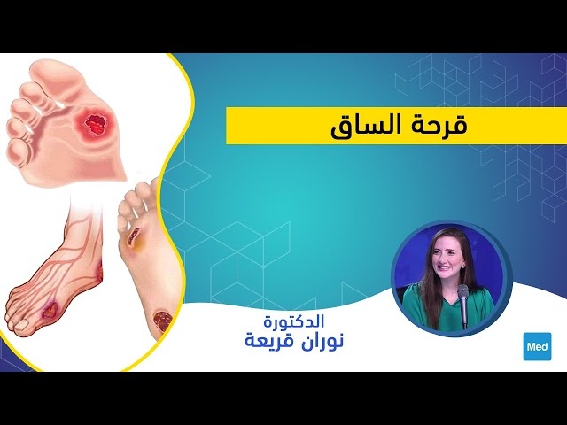 Video قرحة الساق