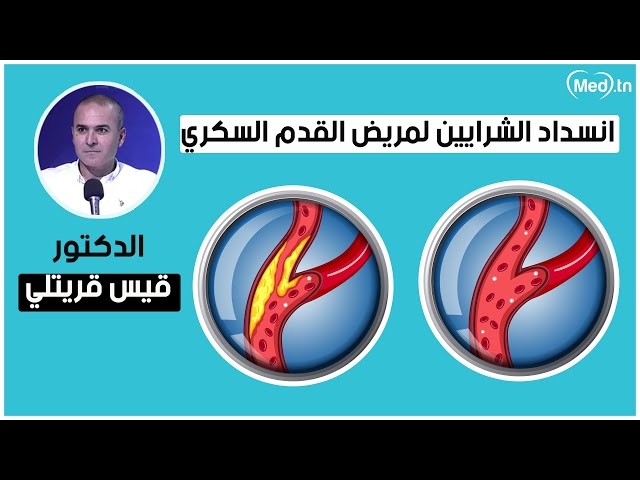 Video مرحلة علاج الشرايين عند مريض القدم السكري
