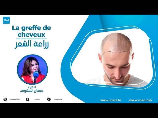 فيديو زراعة الشعر