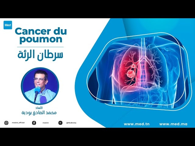 Video Cancer du poumon