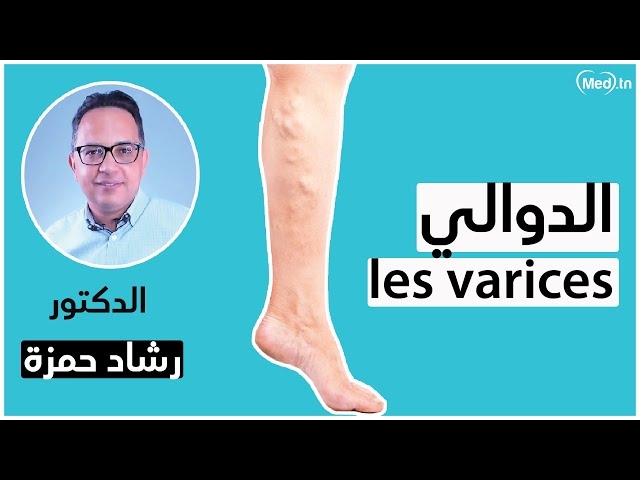 Video les varices 