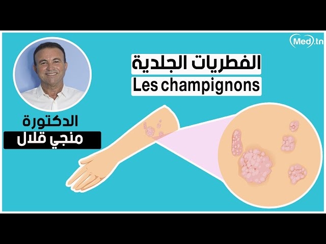 Video  الفطريات الجلدية