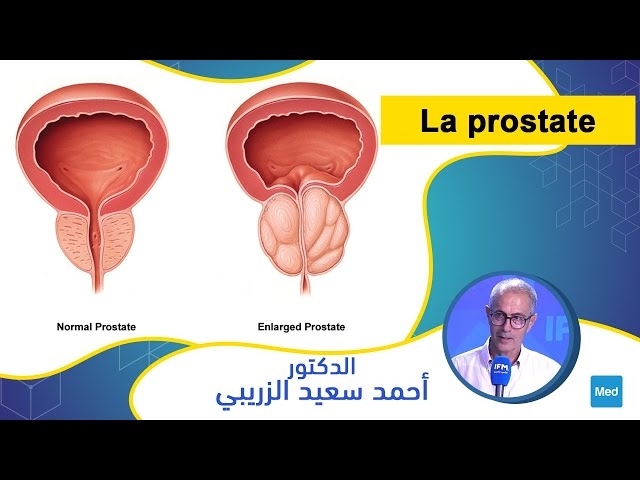 Video La prostate