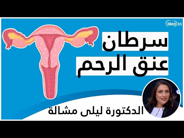 فيديو Cancer chez la femme.