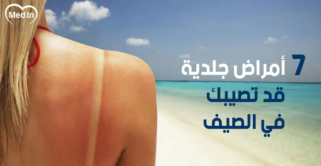 أمراض جلدية قد تصيبك في الصيف 7 