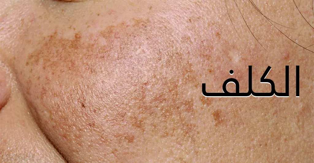 كيفية وقاية البشرة من اشعة الشمس و الحروق