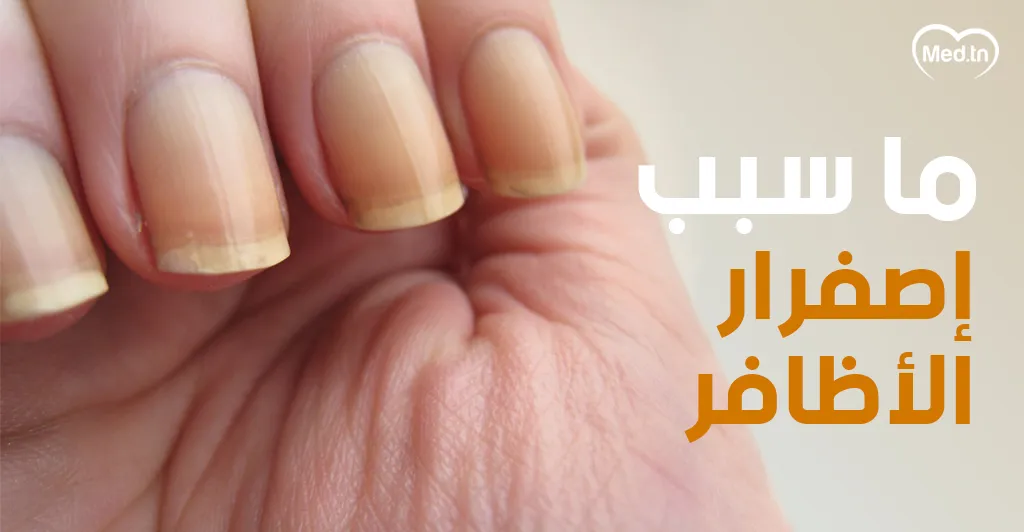 ما  سبب إصفرار الأظافر