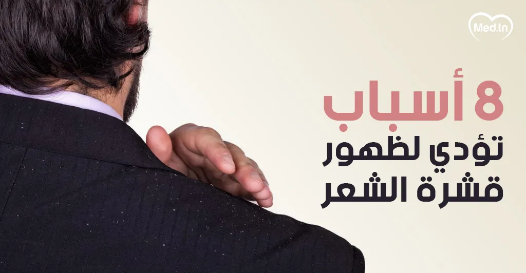 8 أسباب تؤدي لظهور قشرة الشعر 