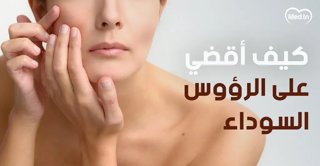 كيف أقضي على الرؤوس السوداء