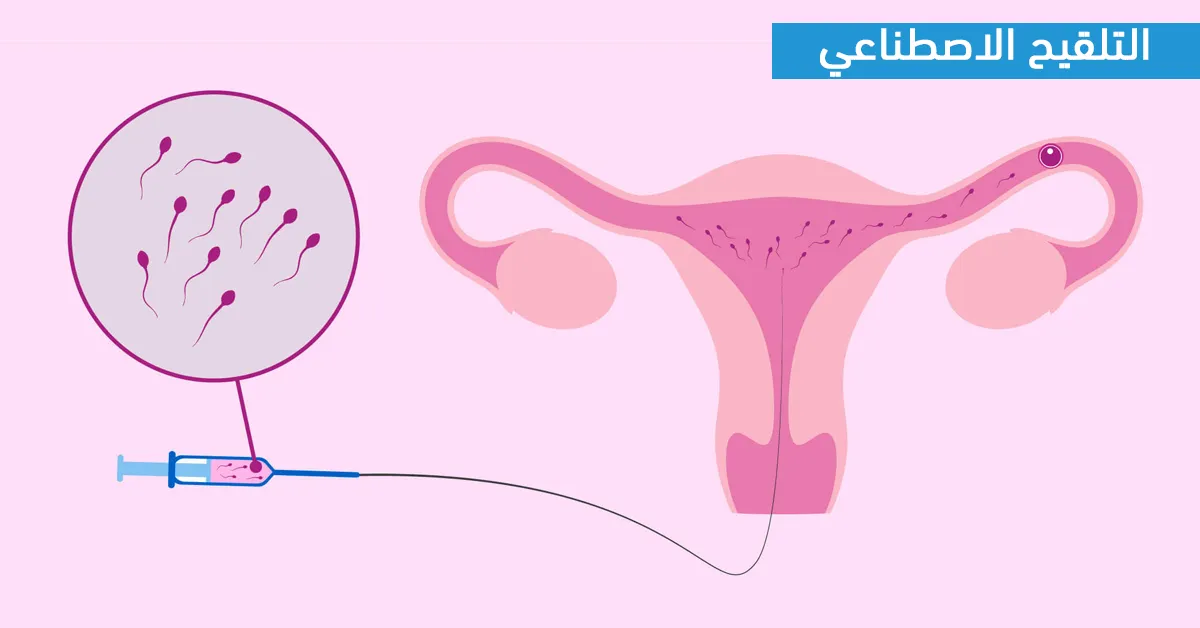 التلقيح الاصطناعي