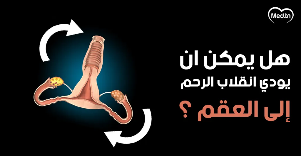 هل يمكن أن يؤدي انقلاب الرحم إلى العقم