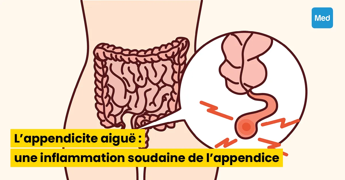 L'appendicite aiguë : une inflammation soudaine de l'appendice
