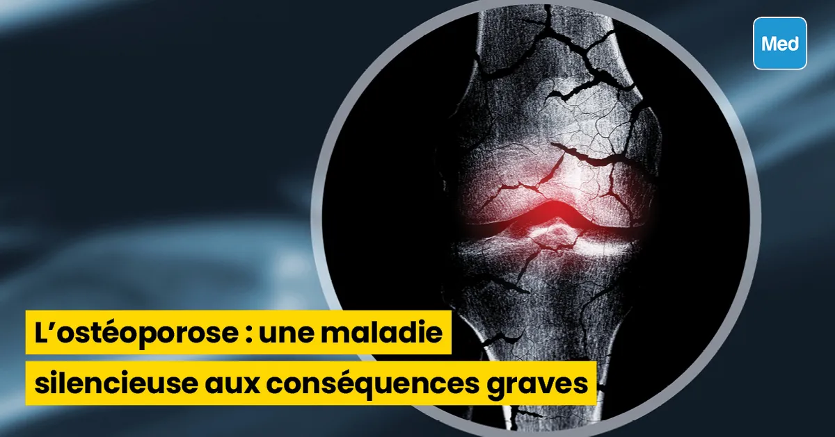 L'ostéoporose : une maladie silencieuse aux conséquences graves