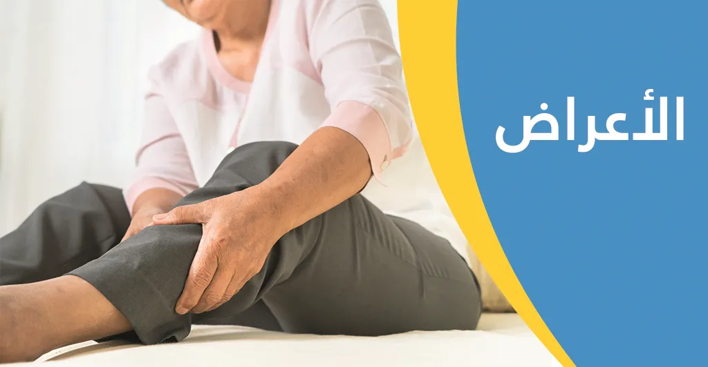 أهمّ أعراض الدّوالي وطرق العلاج