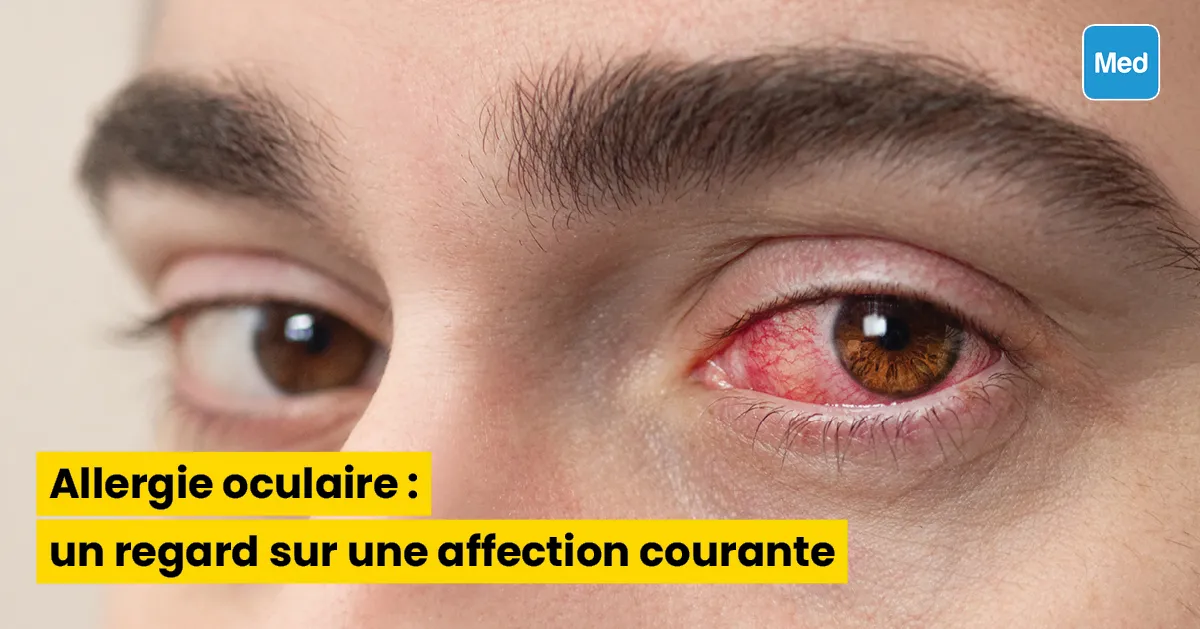 Allergie oculaire : un regard sur une affection courante