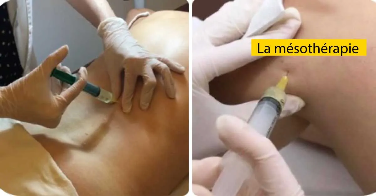 La mésothérapie, une technique de pointe pour soulager la douleur